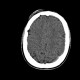 Subdural hemorrhage, minute: CT - Computed tomography